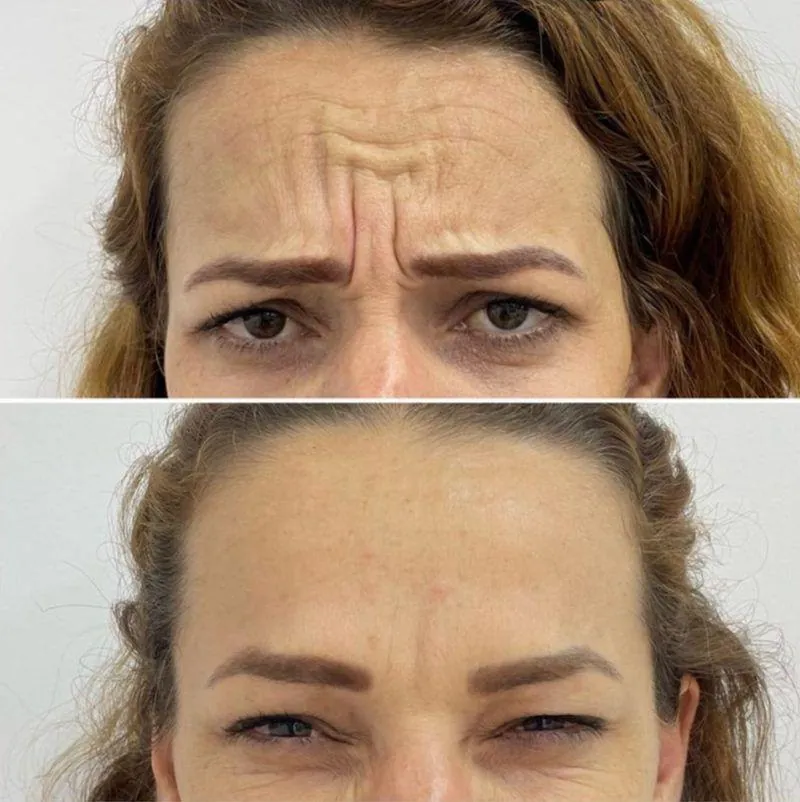 Antes e depois Botox em Belo Horizonte — Dra. Sabrina Chaves