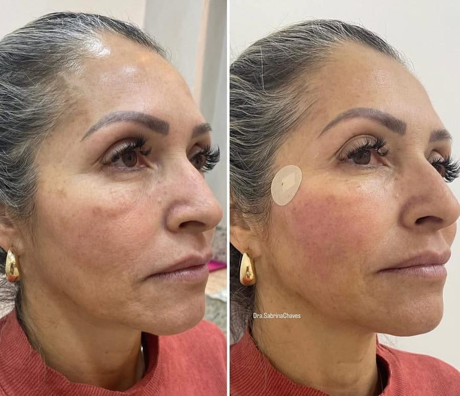 Antes e depois de bioestimulador de colágeno em Belo Horizonte — Dra. Sabrina Chaves
