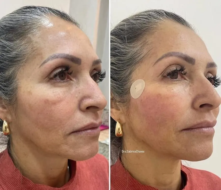 Antes e depois de bioestimulador de colágeno em Belo Horizonte — Dra. Sabrina Chaves