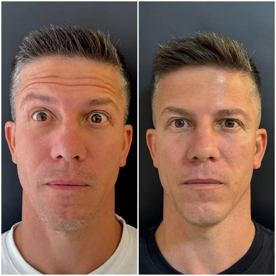 Antes e depois de harmonização facial em Belo Horizonte — Dra. Sabrina Chaves