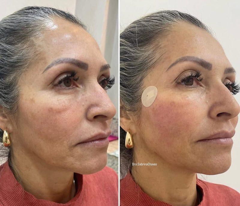 Antes e depois Fios de PDO em Belo Horizonte — Dra. Sabrina Chaves