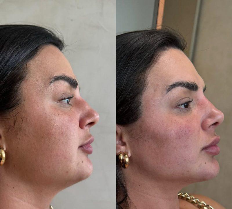 Antes e depois Harmonização Facial em Belo Horizonte — Dra. Sabrina Chaves