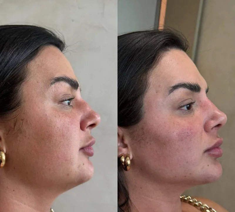 Antes e depois Harmonização Facial em Belo Horizonte — Dra. Sabrina Chaves