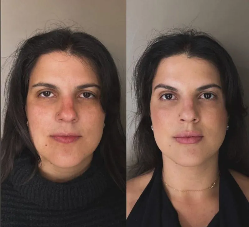Antes e depois Harmonização Facial em Belo Horizonte — Dra. Sabrina Chaves