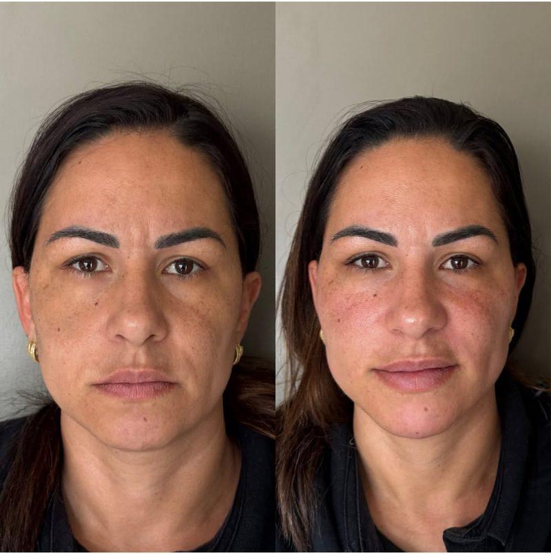 Antes e depois Harmonização Facial em Belo Horizonte — Dra. Sabrina Chaves