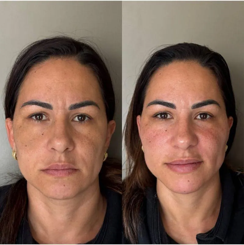Antes e depois Harmonização Facial em Belo Horizonte — Dra. Sabrina Chaves