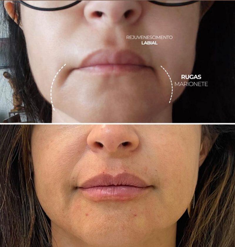 Antes e depois Preenchimento em Belo Horizonte — Dra. Sabrina Chaves
