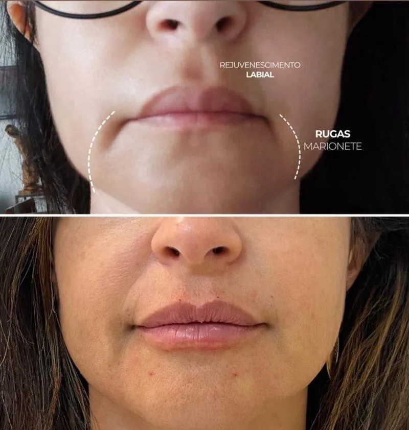 Antes e depois Preenchimento em Belo Horizonte — Dra. Sabrina Chaves