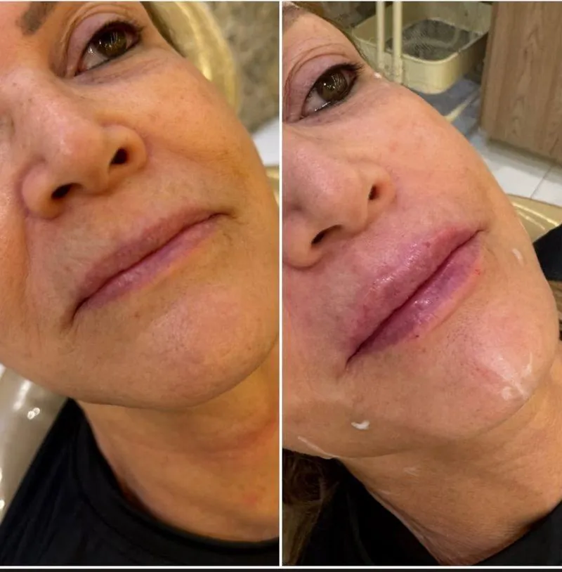 Antes e depois Preenchimento Labial em Belo Horizonte — Dra. Sabrina Chaves