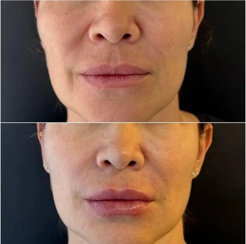 Antes e depois Preenchimento Labial em Belo Horizonte — Dra. Sabrina Chaves