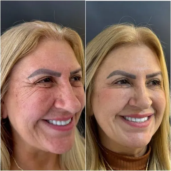 Botox em Belo Horizonte