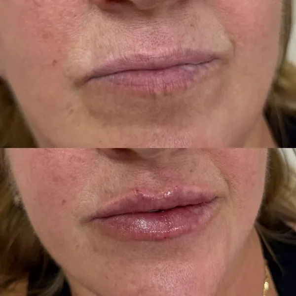 Preenchimento Labial em Belo Horizonte - antes e depois