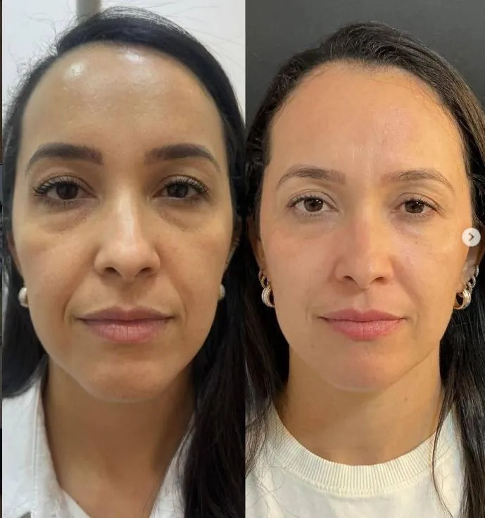 Resultado antes e depois botox Minas Gerais