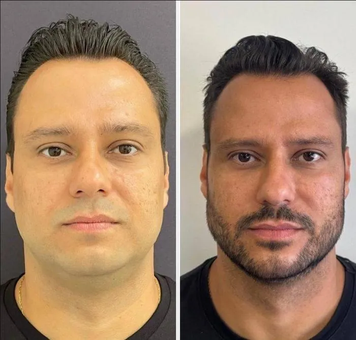 Resultado antes e depois harmonização facial Belo Horizonte