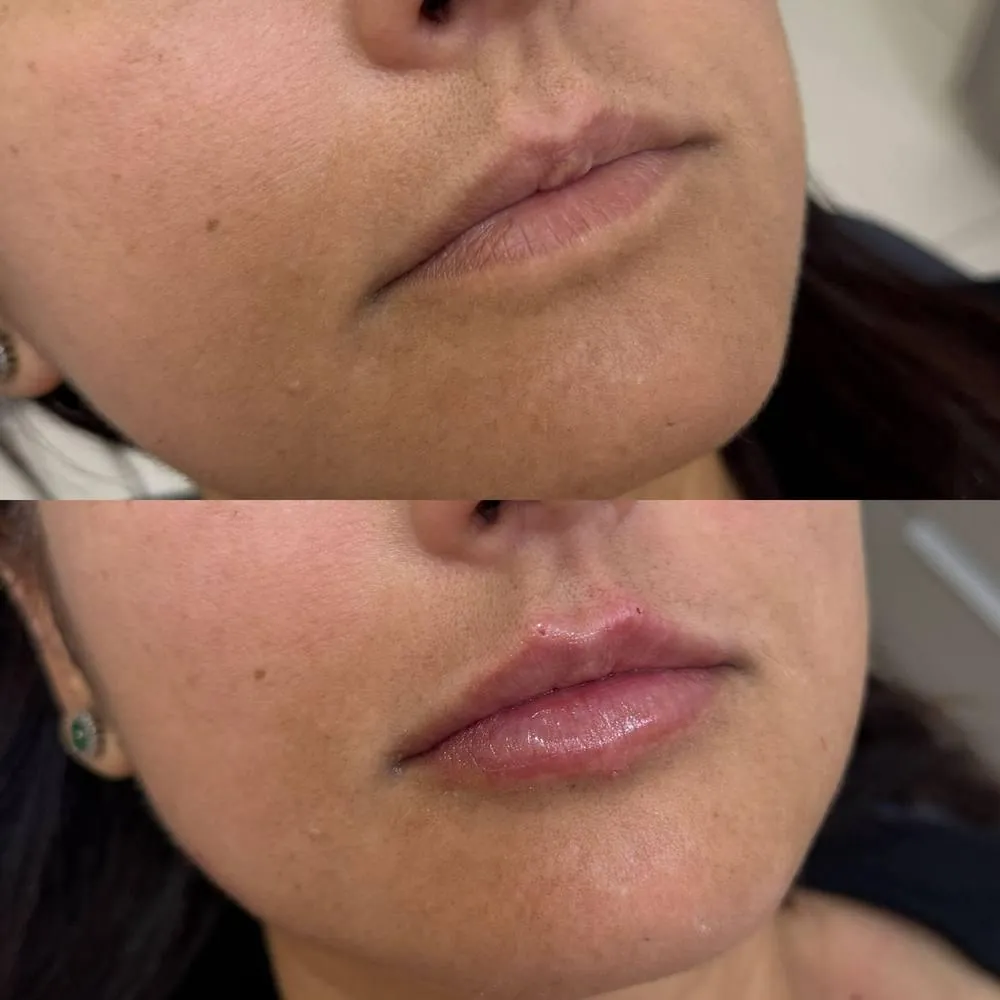 Resultado antes e depois preenchimento BH